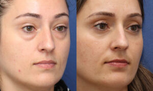 Non-Surgical Solutions before & after